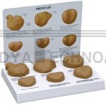 Human Male Prostate Anatomy Model with Patient Education Card